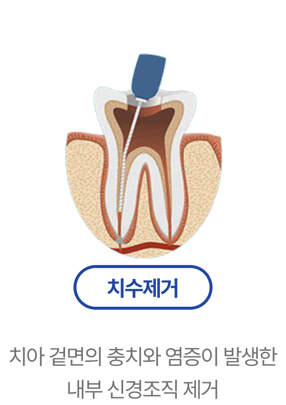 치수제거